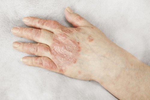 Artrite Psoriásica