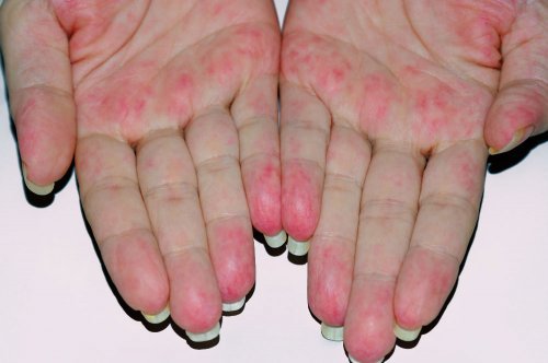 Vasculites